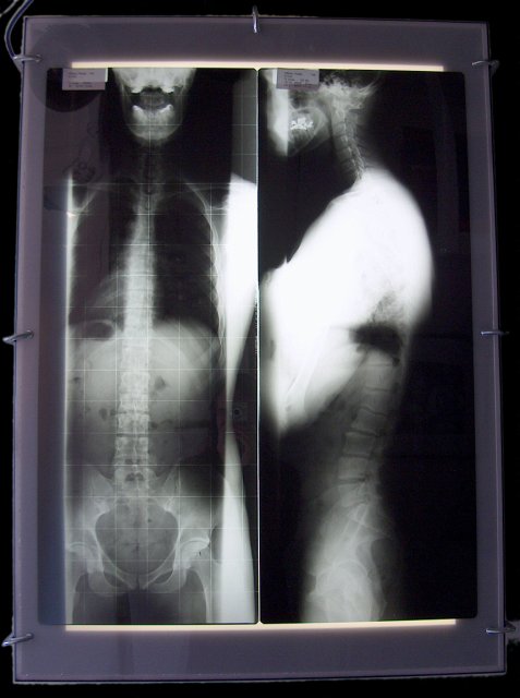 X-Ray Self Portrait.JPG - "Self Portrait After the Half Pipe"  32 x 43 x 6?"  Metal X-ray Light Box, X-ray Negatives, Plexi Glass, Aluminum C-clamps 2005